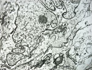 F,12y. | malignant tumor of the orbita - liposarcoma?, neurofibrosarcoma?